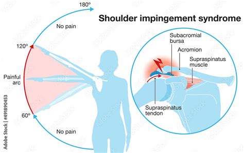 Shoulder Impingement Sydrome Painful Arc Labeled Illustration Stock