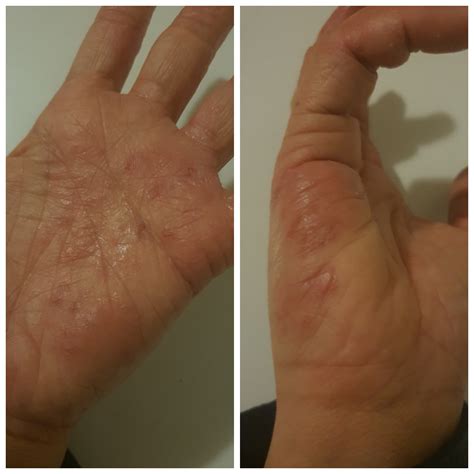Does This Look Like Dyshidrotic Eczema Or Does Anyone Elses Do This