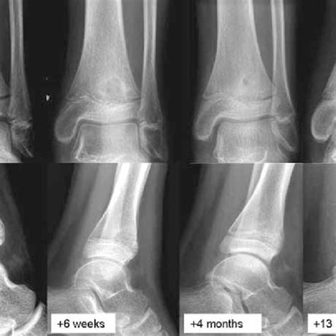 Subacute Oteomyelitis Of The Distal Tibial Metaphysis In A 11 Year Old