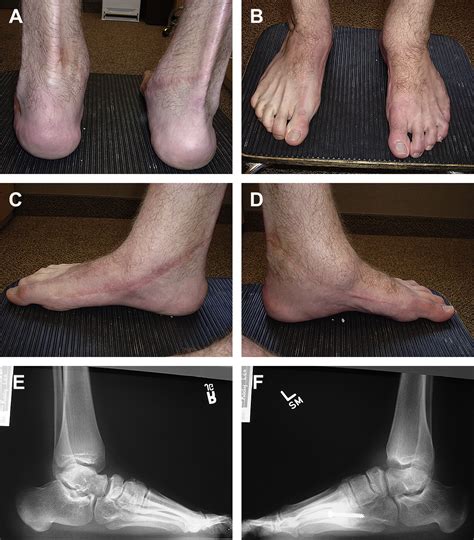 The Adult Sequelae Of Treated Congenital Clubfoot Foot And Ankle Clinics