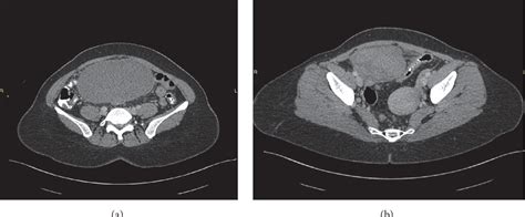 Figure 1 From Rare Case Of Leiomyoma And Adenomyosis In Mayer