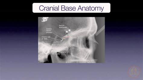 Cranial Base Superimposition Youtube
