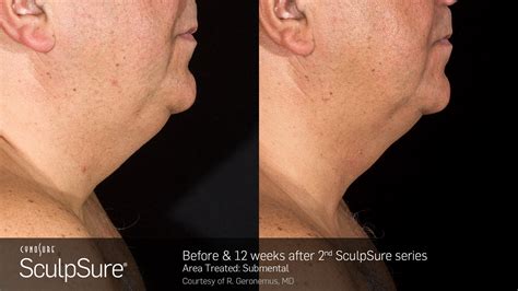 Sculpsure Submental Before And After Photos Vita Aesthetics