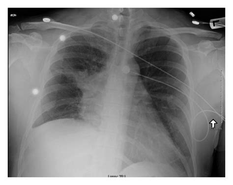Chest X Ray Showing A Large Right Hilar Mass Extending To The Right