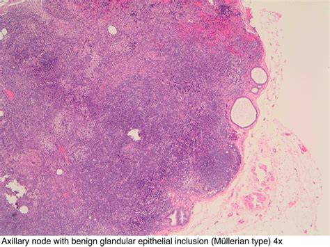 Pathology Outlines Axillary Lymph Nodes