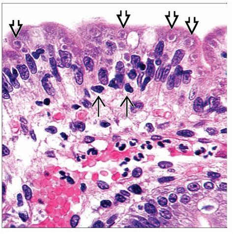 Pathology Outlines Hivaids Associated