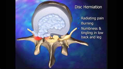 11 Lumbar Spine Disc Injury Youtube