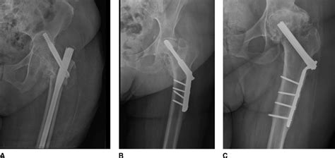 Total Hip Arthroplasty For Posttraumatic Conditions Jaaos Journal