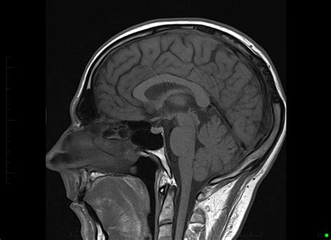 Brain Without Contrast Showing Normal Enhancement Of The Pituitary Gland Mri At Melbourne