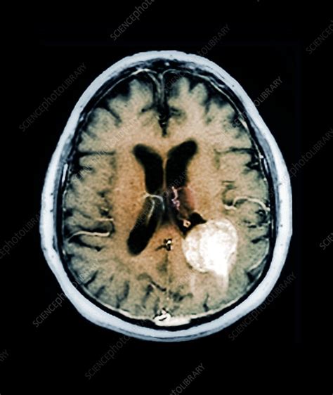 Benign Brain Tumour Mri Scan Stock Image C0147062 Science Photo