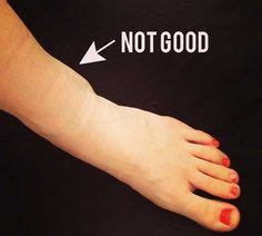 In addition, bruising is frequently seen. Symptoms for Ligament Tear In Ankle #JointsTreatment ...