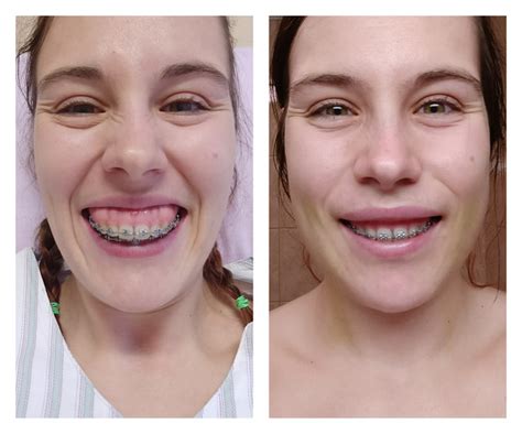 Double Jaw Surgery Lip Incampetence Overbite Gummy Smile