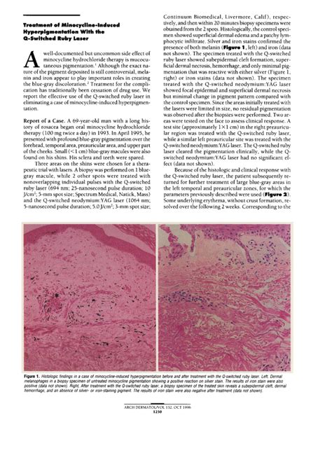 Treatment Of Minocycline Induced Hyperpigmentation With The Q Switched