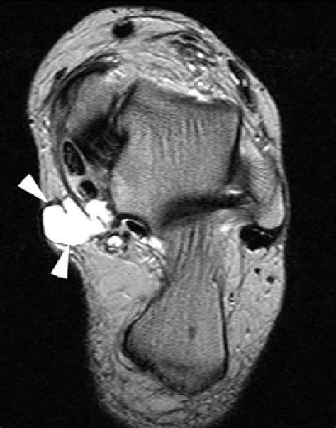 Tarsal Tunnel Syndrome Axial T2 Weighted Image Demonstrating A