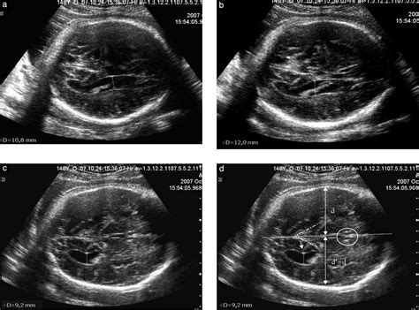 Fetal Cerebral Ventricular Measurement And Ventriculomegaly Time For