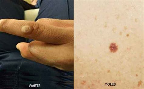 The Difference Between Wart And Mole Team Dermatology
