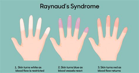 Raynauds Phenomenon Foot Right Podiatry