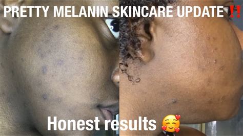 Pretty Melanin Skincare Upate‼️5 Week Results Youtube