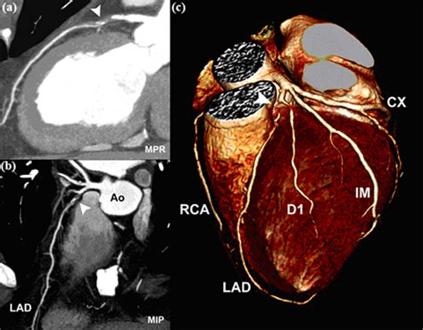 Ct Coronary Angiography Cardiac Health