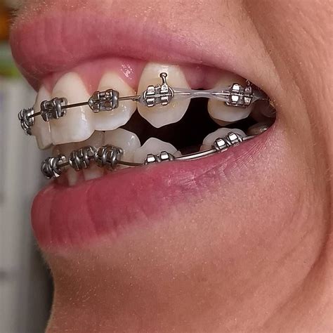 Bloggingforfun6395 Metal Braces On Bottom Teeth