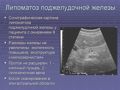 Печень лечение диета увеличенная причины Поджелудочная железа увеличенная: причины и лечение патологии Поджелудочная железа увеличенная: причины и лечение патологии Печень лечение диета увеличенная причины
