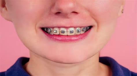 The Best Braces Colors The Comprehensive Guide In