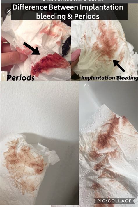 Twins Implantation Bleeding Twice Kulturaupice