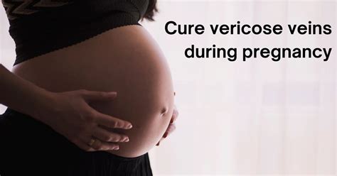 How To Cure Varicose Veins During Pregnancy And Post Pregnancy