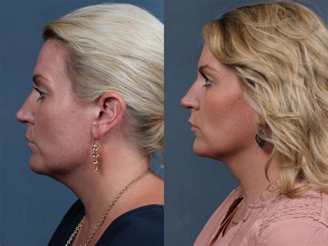 Kybella Before And After Photo Gallery Louisville Ky Calospa