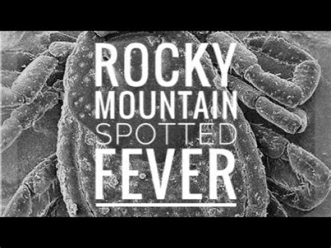 Recognize rocky mountain spotted fever early to get prompt and potentially lifesaving treatment. Rocky Mountain Spotted Fever (Rickettsia rickettsii) - YouTube