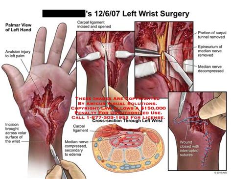 AMICUS Illustration Of Amicus Surgery Wrist Avulsion Injury Palm Incision Volar Surface Carpal