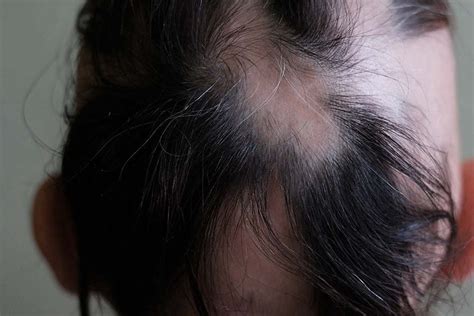 3 Signs Of Regrowth In Alopecia Areata Lady Alopecia