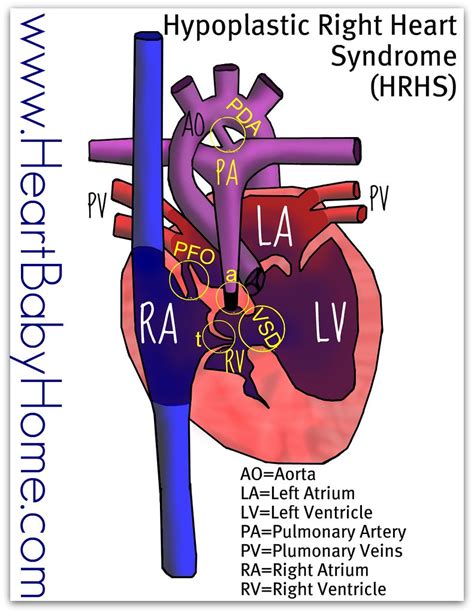 Hrhs Heart Image Hypoplastic Right Heart Syndrome The R Flickr