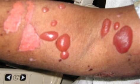 What Is Bullous Pemphigoid Bullous Disease Pigmentation Disorders