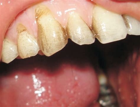 Calvin smith, 2009 extrinsic causes of the teeth turning black come from the outside of the tooth. Dentist black stain on teeth brush clean