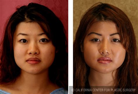 Patient Asian Rhinoplasty Before And After Photos Encino Plastic Surgery Gallery