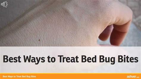 Best Ways To Treat Bed Bug Bites Youtube