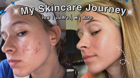 My Skincare Journey How I Cleared My Acne Youtube