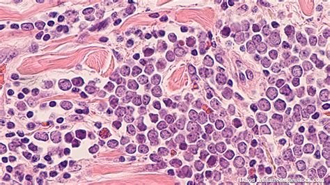 Merkel cell carcinoma (mcc) gets its name because these skin cancer cells resemble merkel cells, which are located in the top layer of skin. Immunotherapy Drug Used As 1st-Line Therapy for Merkel ...
