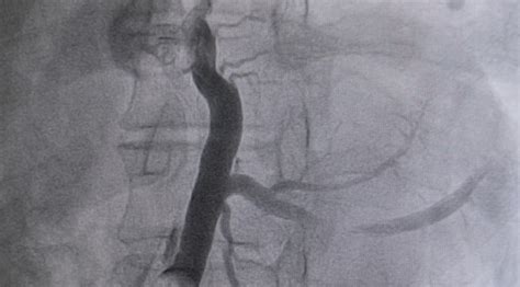 400 x 257 gif 32 кб. Coronary Sinus - The Definitive Guide | Biology Dictionary