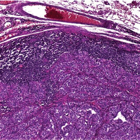 Lymph Node Metastasis Of Papillary Thyroid Carcinoma Hematoxylin And