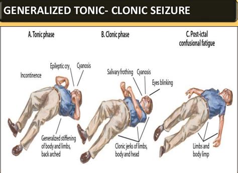 Grand Mal Seizure Causes Symptoms After Effects Recovery Time