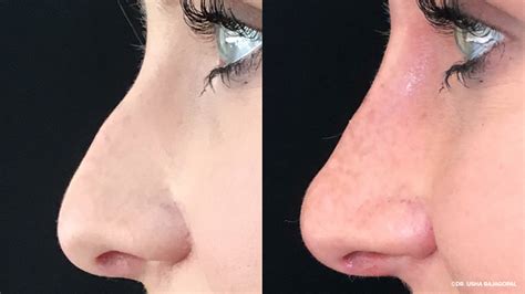 the cost of a non surgical nose job in toronto justinboey