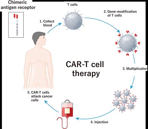 Car T Is Expected To Cure Systemic Lupus Erythematosus Blog