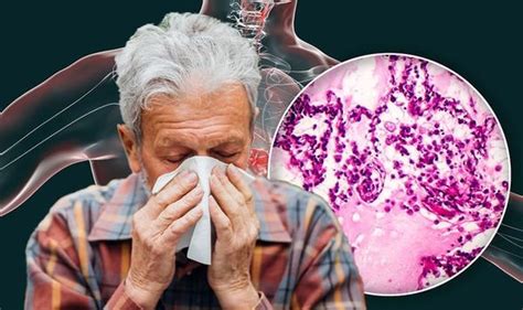 Lung Cancer Symptoms Signs In Your Cough To Watch Out For Uk