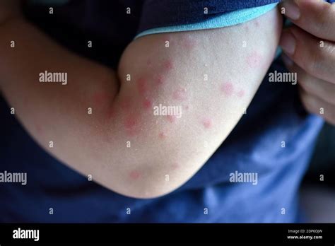 Child With Hives On His Arm Hives Also Known As Urticaria Is A Kind