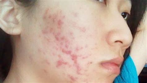 Cystic Acne On Neck Guide For Your Skin Problem