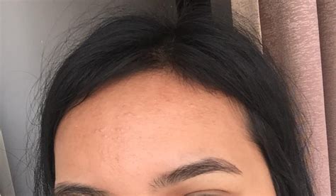 How I Cleared My Tiny Bumps On Forehead Once For All Artofit
