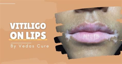 Vitiligo On Lips Vitiligo Treatment