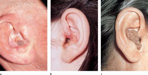 Ear Skin Cancer Signs